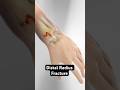 This Reflex Can Break Your Wrist (3D Animation)