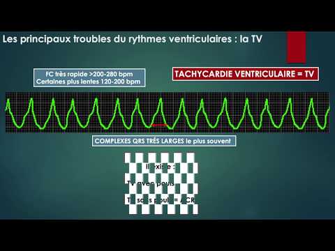 Lecture simple d’un ECG  3 _les principaux troubles du rythmes ventriculaires_les chats noirs du 3SM