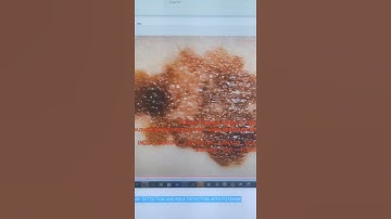 SKIN LESION IMAGE SEGMENTATION BOUNDARY DETECTION AND EDGE DETECTION WITH FILTERING