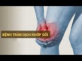 Tràn dịch khớp gối: Phương pháp điều trị và cách phòng ngừa