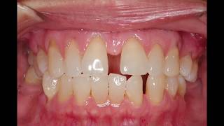 Invisalign Spacing: Nirenblatt Orthodontics