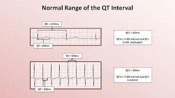 What is long QT in ECG?