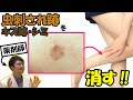 なかなか消えない【跡・シミ】を消す方法紹介!オススメの製品と日常生活での対策編