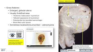 Uterus: Adenomyosis - Microscopy (Talking slide)