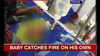 A Three-Month-Boy Suffering Of The Spontaneous Human Combustion