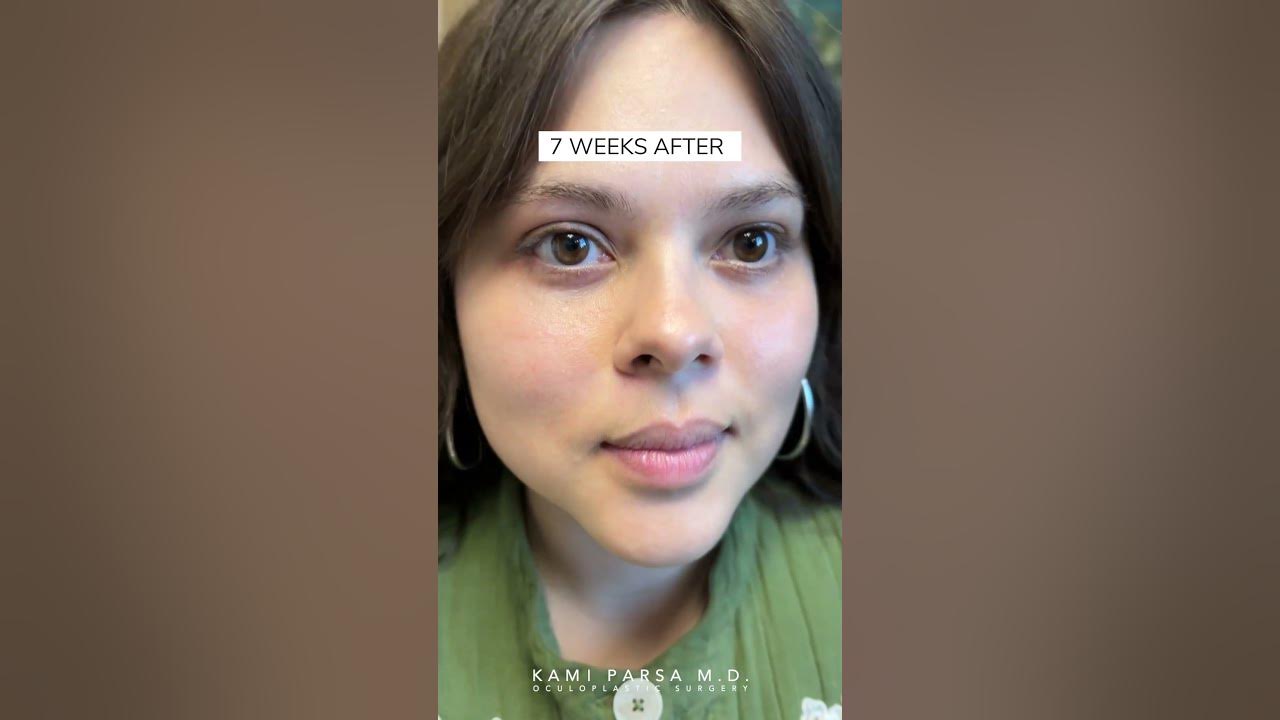 Lower Blepharoplasty With Fat Transfer Before And After Results trifecta-lift-get-rid-of-dark-circles-bags-puffy-lower-eyelids-dr