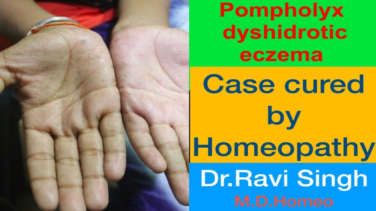 Pompholyx or Dyshidrotic Eczema Homoeopathic Cured Case - YouTube