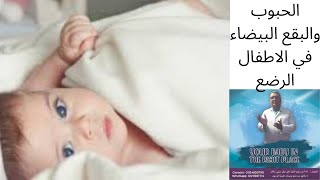 الحبوب او البقع البيضاء في الاطفال الرضع/علاج الحبوب