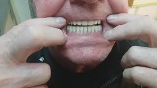 Egy Nem Mindennapi Fogsor