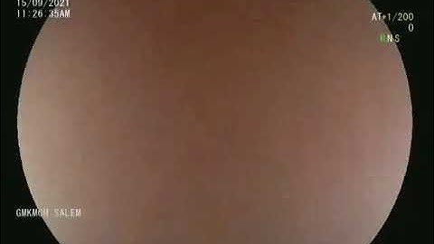 Coin in the stomach - retrieved with Roth net