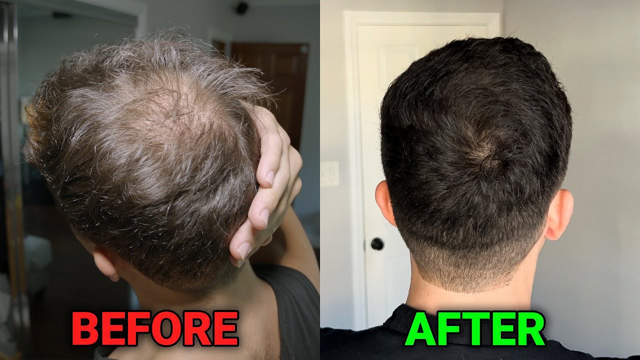 Minoxidil 1 year later: pros and cons