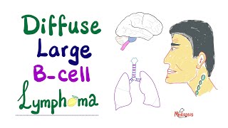 Diffuse Large B-Cell Lymphoma (DLBCL) | Aggressive  B-Cell Non-Hodgkin’s Lymphoma