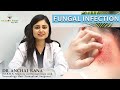 Fungal infection  fungal infection and its types  treatment of fungal infection by dr anchal rana