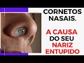 Carne esponjosa: o que sāo cornetos nasais e como é turbinectomia ? Otorrino em Curitiba