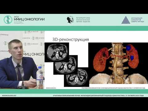 Video: Submillimetrinės Retinoblastomos Stebėjimas Po Transpupilinės Termoterapijos, Naudojant Rankinę Optinę Koherentinę Tomografiją