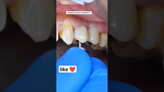 روعة زراعة الأسنان | dental implants dr_abdullah_sultan_dentist dentist 소아치과