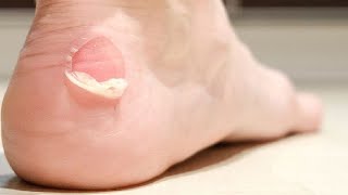 how to get rid of blisters on feet overnight