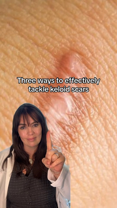 How to get rid of keloid scars non-surgically👆🏽 #keloid #keloidtreatment #scarremoval #scarring