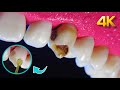 Eliminación de caries dental en 4K