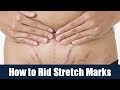 How to Rid Stretch Marks