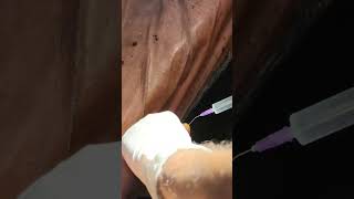 Abscess over finger minor ot ....Sensitive content 