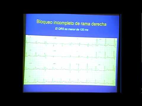 Vídeo: Su Bloqueo De Rama: Signos, Tratamiento, Causas