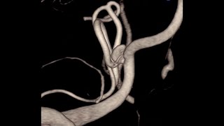 Download Lagu Aneuryms PICA - Simple embolization MP3 Download Lagu Aneuryms PICA - Simple embolization MP3