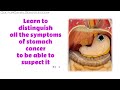 Stomach Cancer - All Symptoms