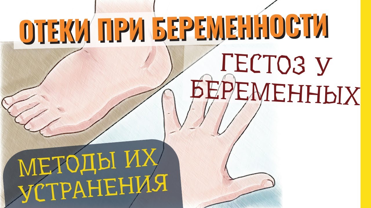 Сильно отекаю при беременности. Отекание при беременности. Гестоз отеки при беременности. Как снять отек у беременной 3 триместр.