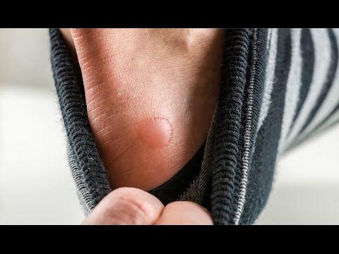 Video: Ar trebui să scurgi un blister?