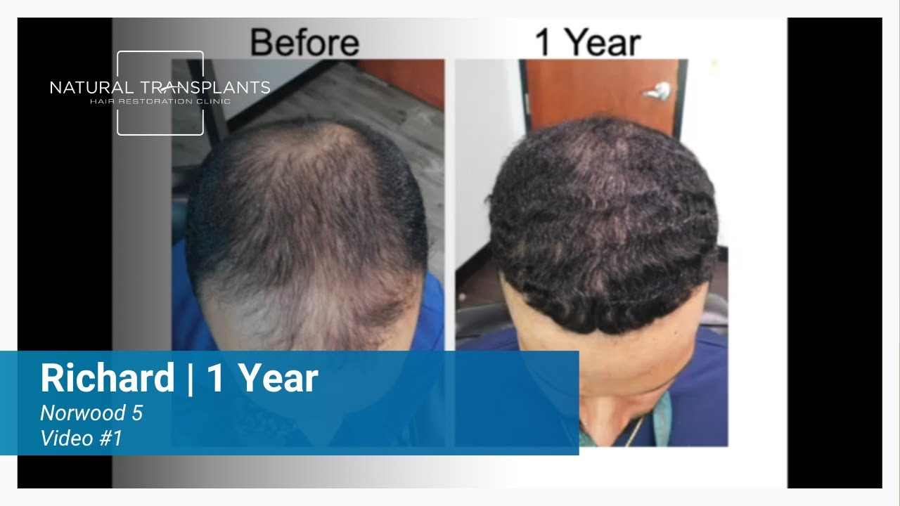 Norwood 5 Hair Transplant Transformation – 1 Year Follow Up and Results | Dr. Siegel (Richard)