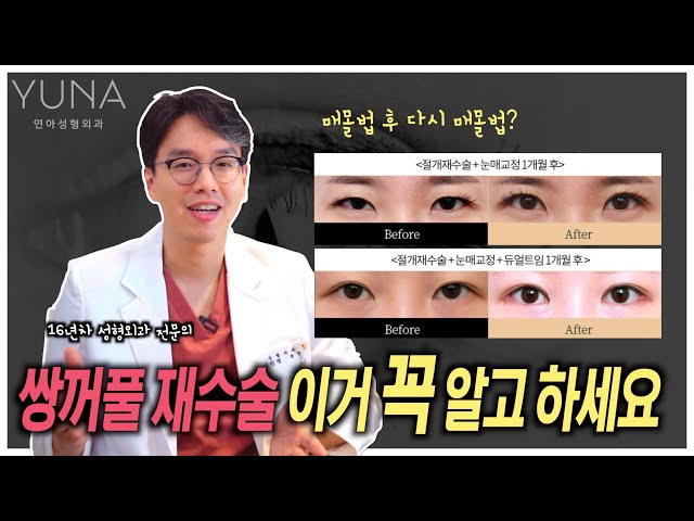 쌍꺼풀재수술 이거 꼭 알고하세요! 매몰법 했는데 또 매몰법이 가능할까요?