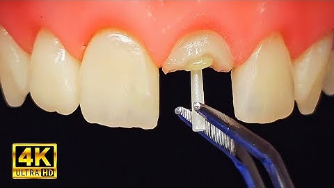 Satisfying Rebuild of a Broken Front Tooth with Post & Crown!