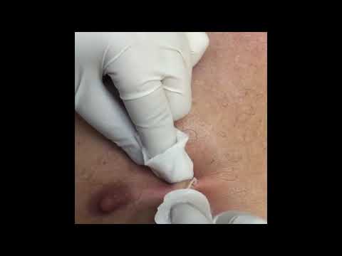 Giant Chest acne removal blackhead  - How to REMOVE BLACKHEADS