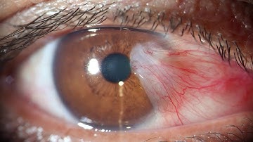 Pterygium & Pingueculum