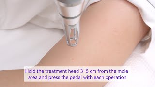 How To Remove Moles With Professional Qswitched Picosecond Laser  Hrj205 Tutorial