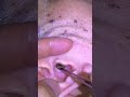 Ear Cleaning #314