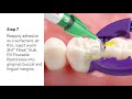 Bioclear™ Class II Restorations Video