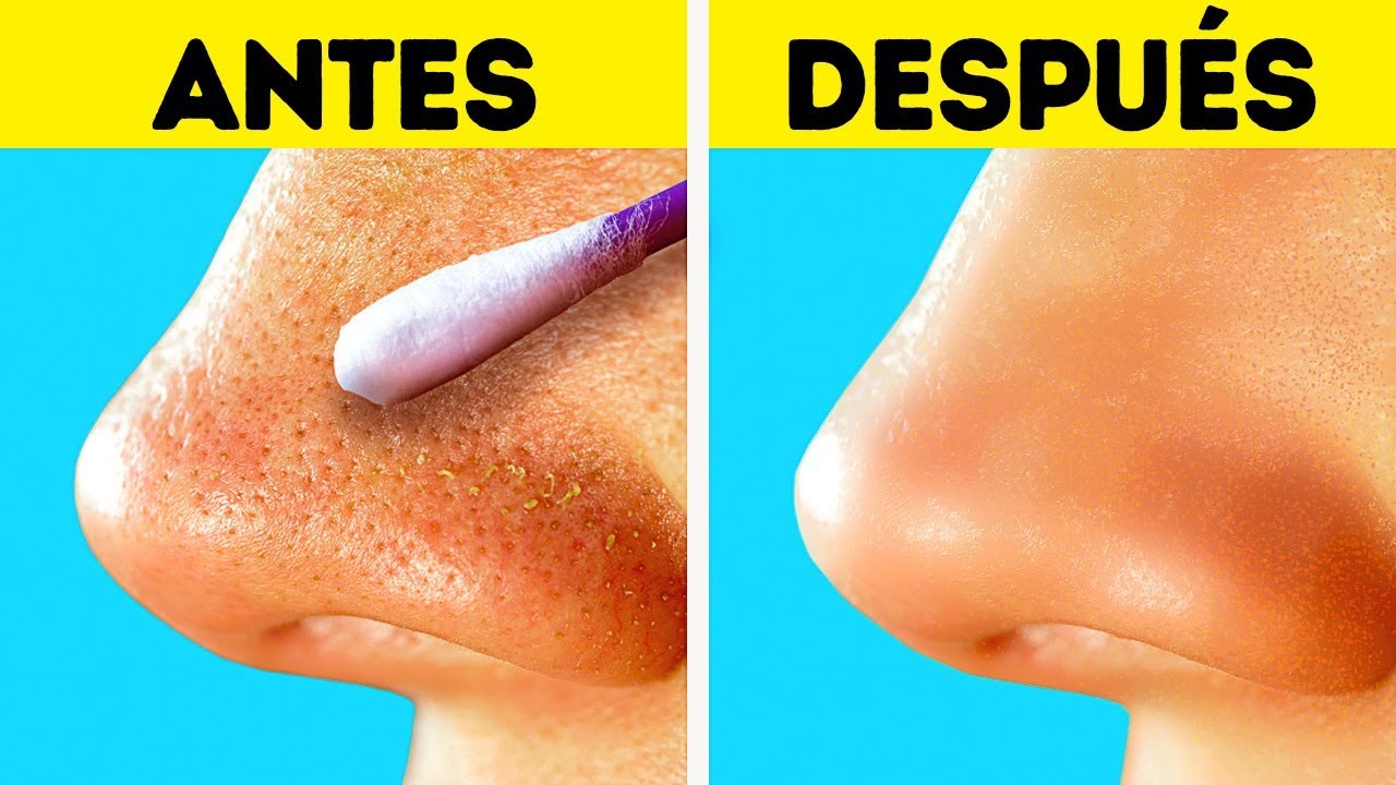 Como quitar las marcas de acne