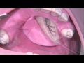 Operative removal of an impacted canine