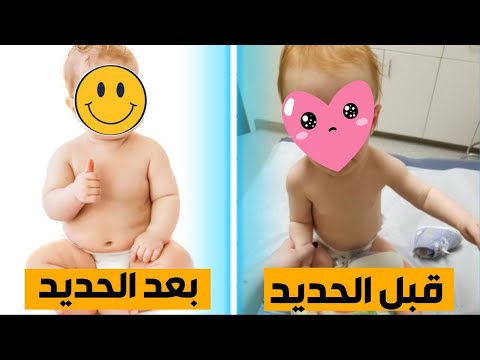 نقص الحديد غيرت حياة الاطفال الأعراض و الوقاية و العلاج