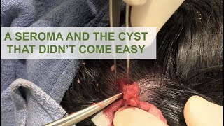 A Seroma and a Cyst | Dr. Derm