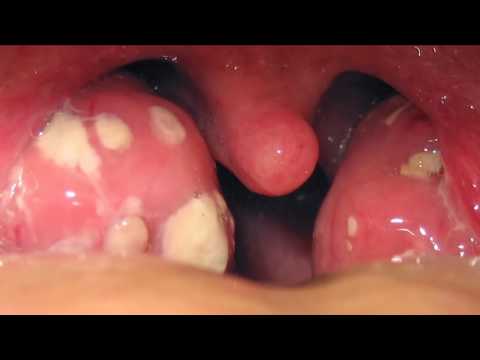 Video: Batuk Batu Tonsil