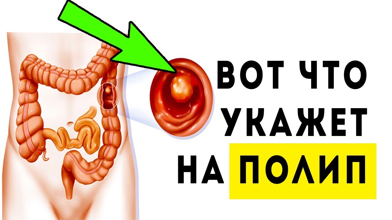 Это говорит о полипах и повреждении стенок ЖКТ