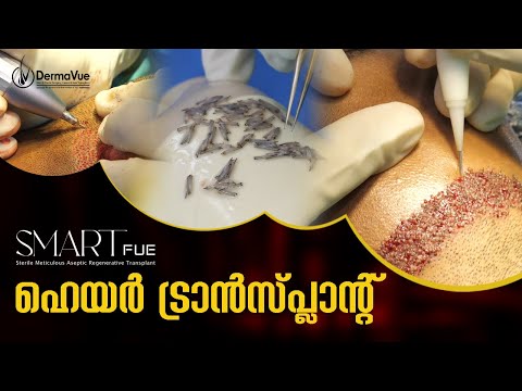 SMART FUE Hair Transplantation Explained | Safe and Effective Solution