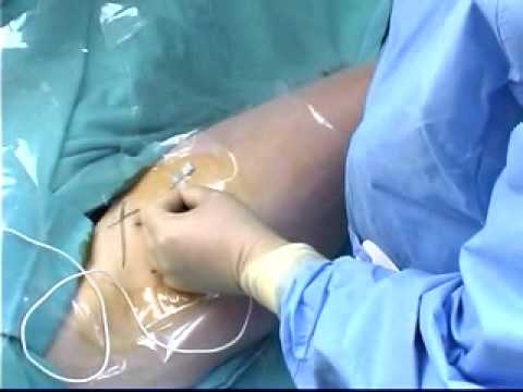 continuous femoral nerve block - youtube continuous femoral nerve block - youtube, Muscles