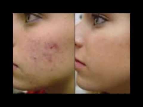 skinception dermefface fx7 skinception dermefface fx7