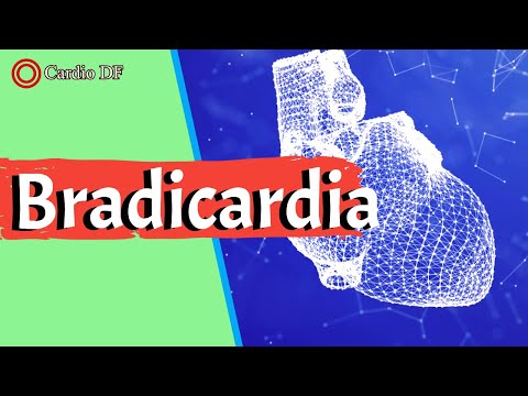 Vídeo: Bradicardia Sinusal - Tratamento, Bradicardia Sinusal Moderada