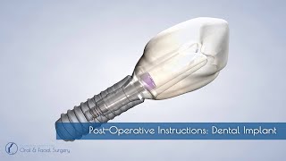 Dental Implant Aftercare: Post-Op Instructions & Recovery Tips