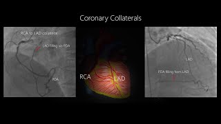 Coronary Collateral Circulation with Angiographic examples